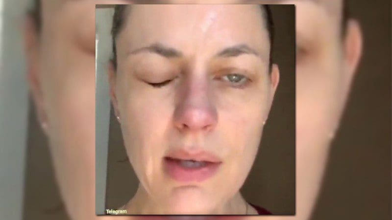 canadian-actress-reveals-she-has-bell’s-palsy-two-weeks-after-vax,-says-she-would-take-it-again