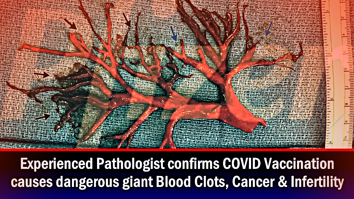 experienced-pathologist-confirms-covid-vaccination-causes-giant-blood-clots,-cancer-&-infertility