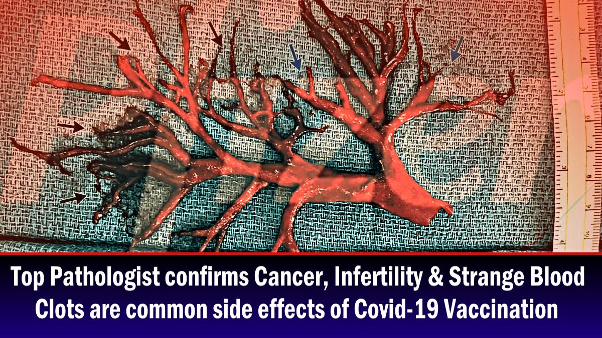 top-pathologist-confirms-cancer,-infertility-&-strange-blood-clots-are-common-side-effects-of-covid-19-vaccination